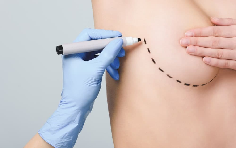 Bruststraffung mit Eigengewebe statt Implantaten: Ein Blick auf die Autoaugmentation und den inneren BH
