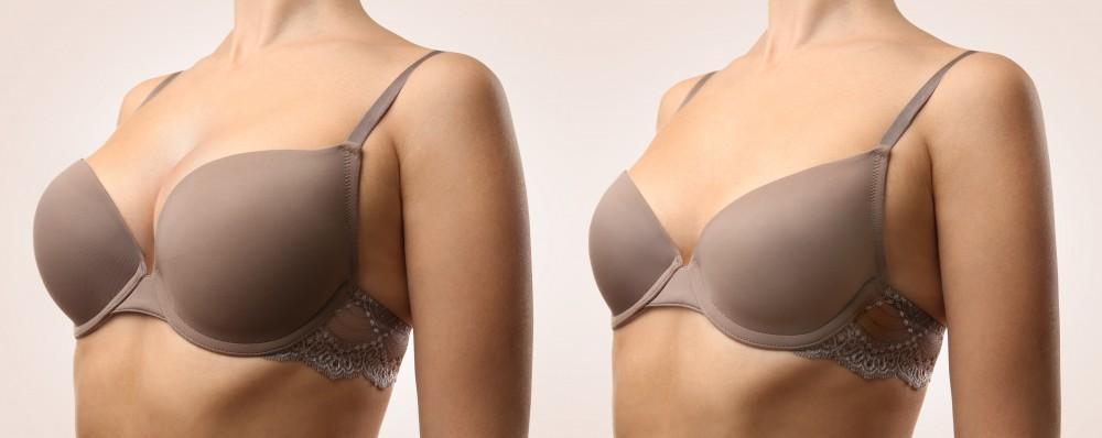 Bauchdeckenstraffung für Männer: Ein wachsender Trend
